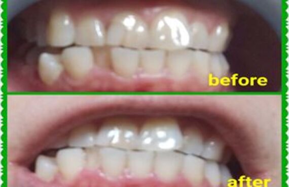 セルフホワイトニング！！1回3000円